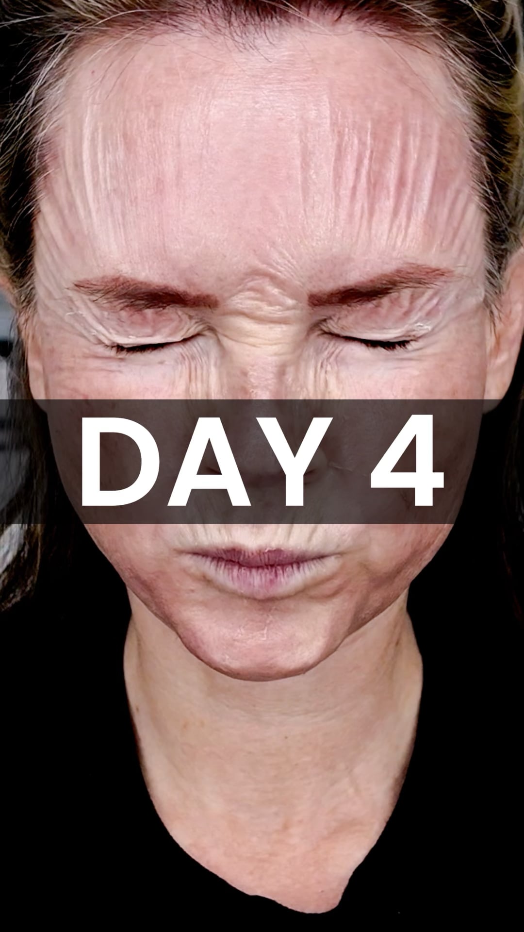 25% TCA Peel: Day 4 video