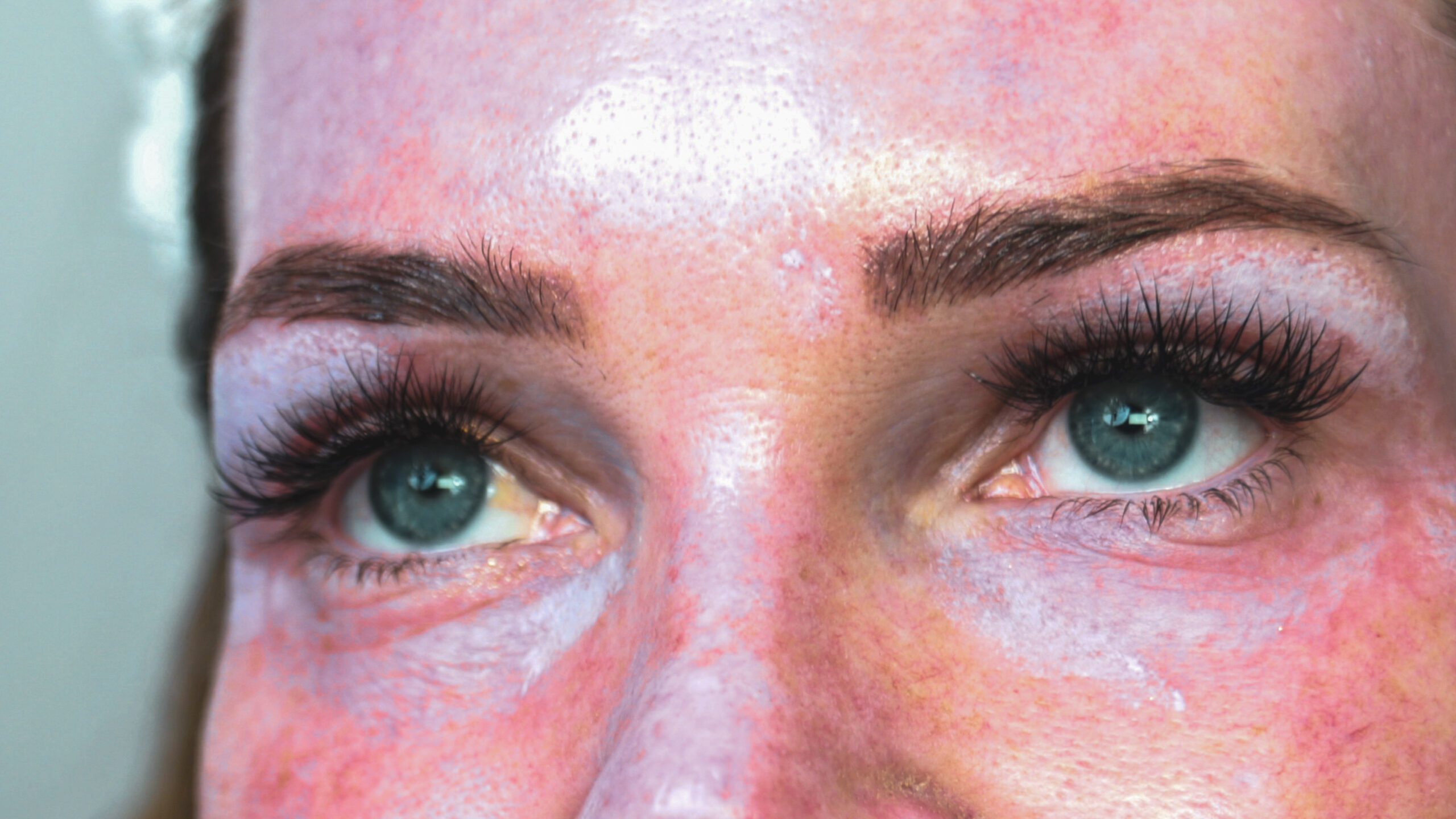 DIY TCA 30% + 5% Salicylic Peel - treatment image