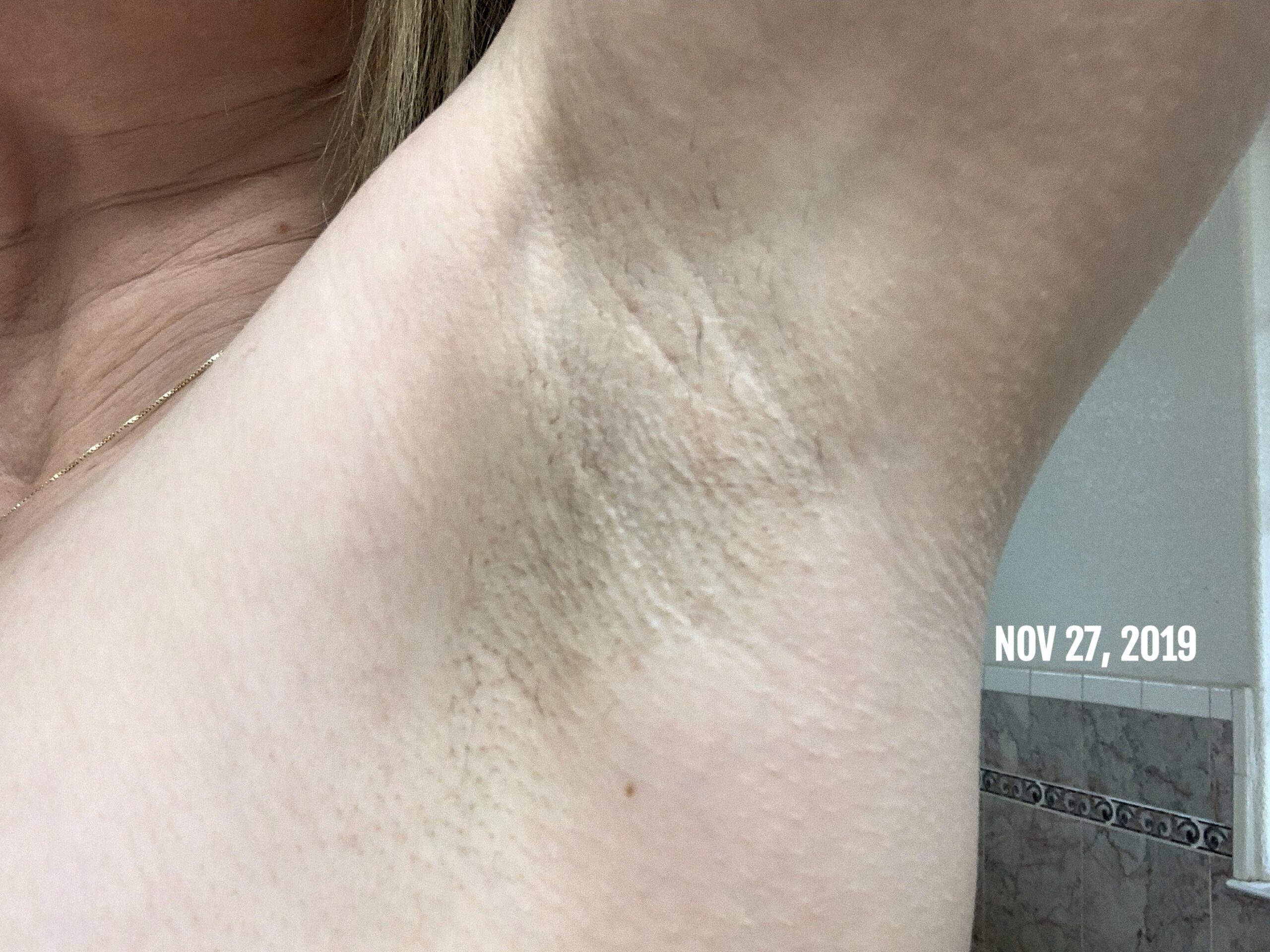 IPL Laser HAIR Removal At HOME - treatment image