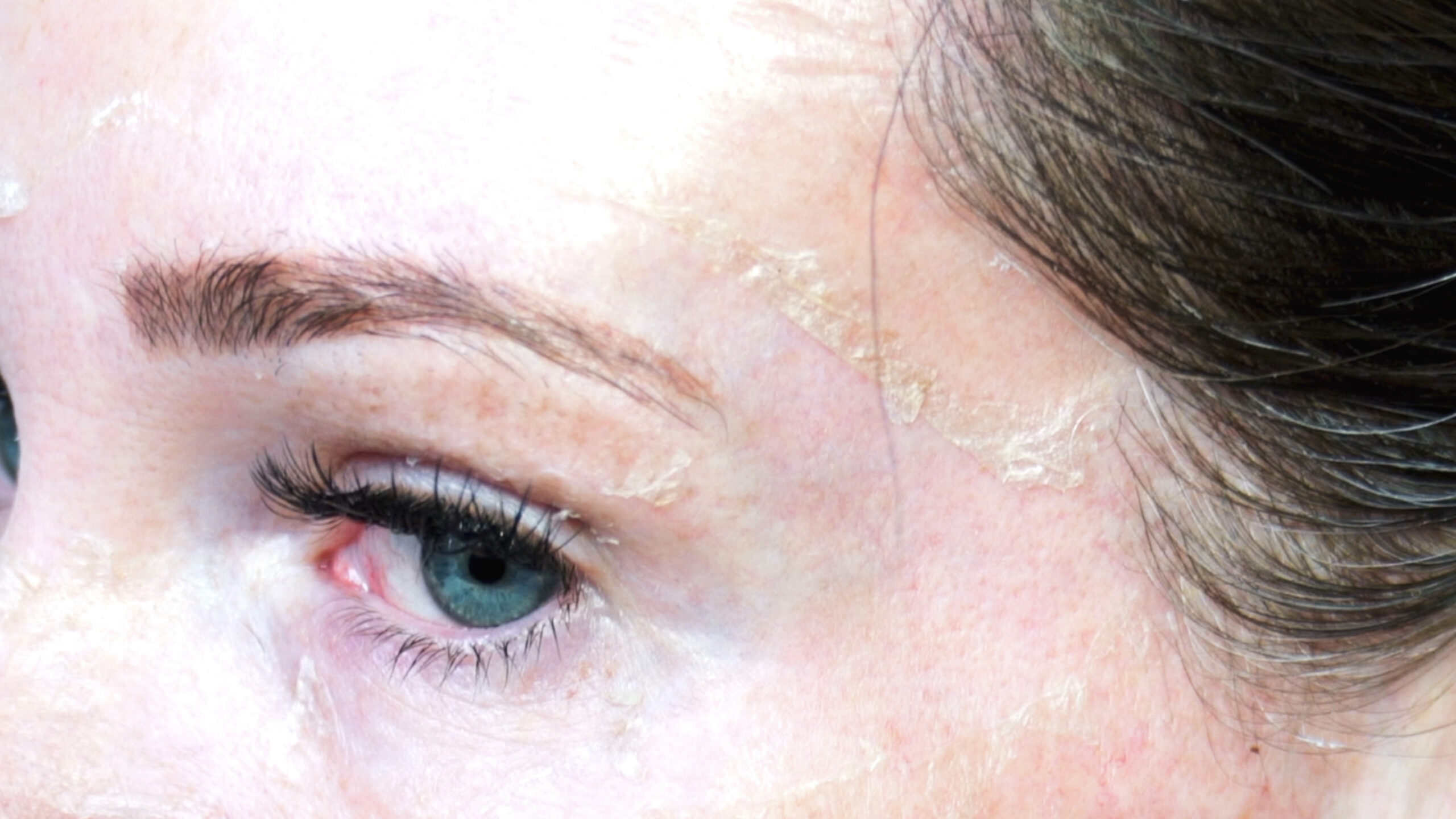 DIY TCA 30% + 5% Salicylic Peel - treatment image