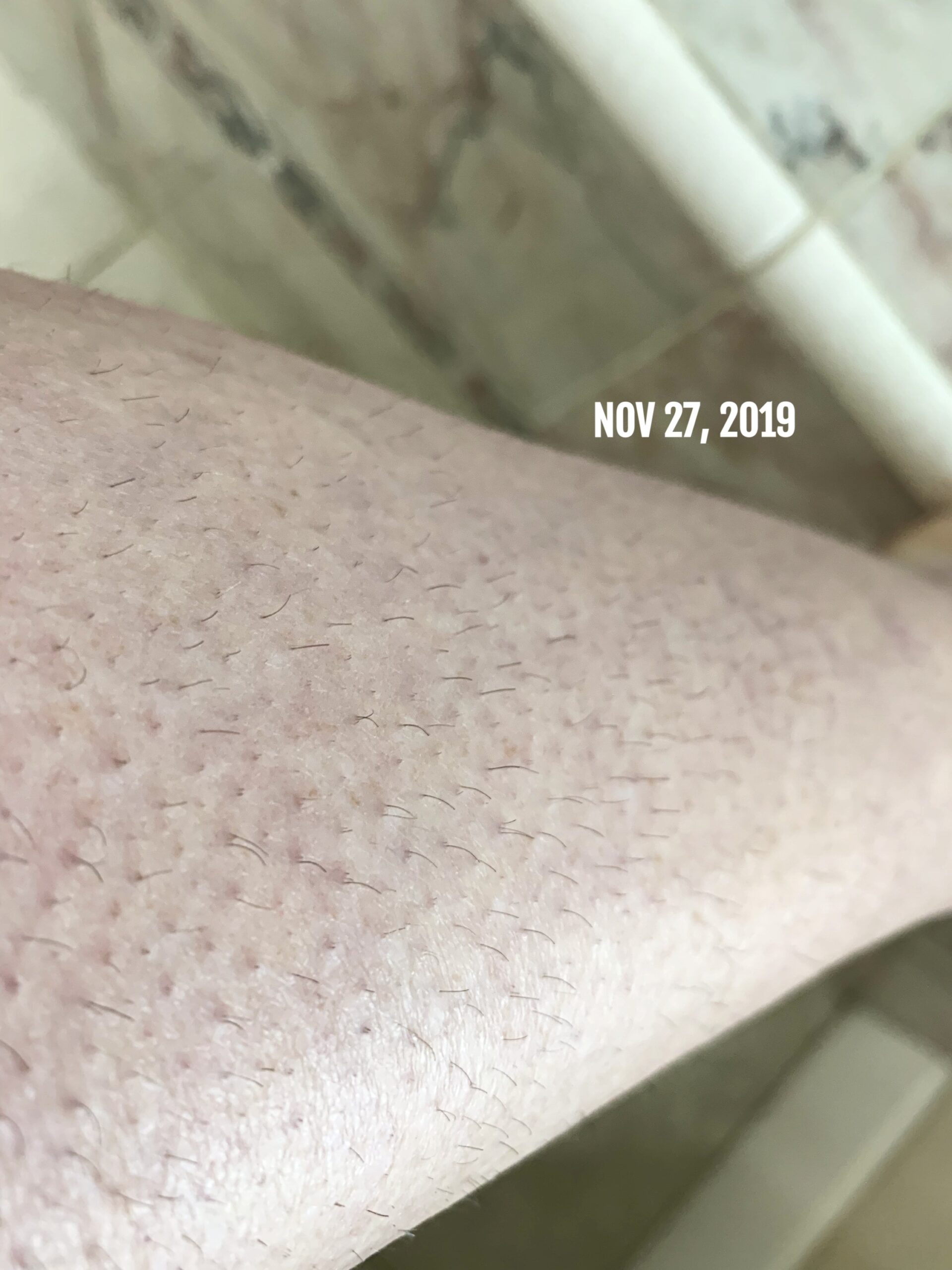 IPL Laser HAIR Removal At HOME - treatment image