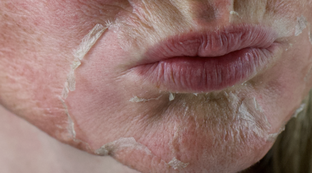 CHEMICAL PEELS 101: Acid Types