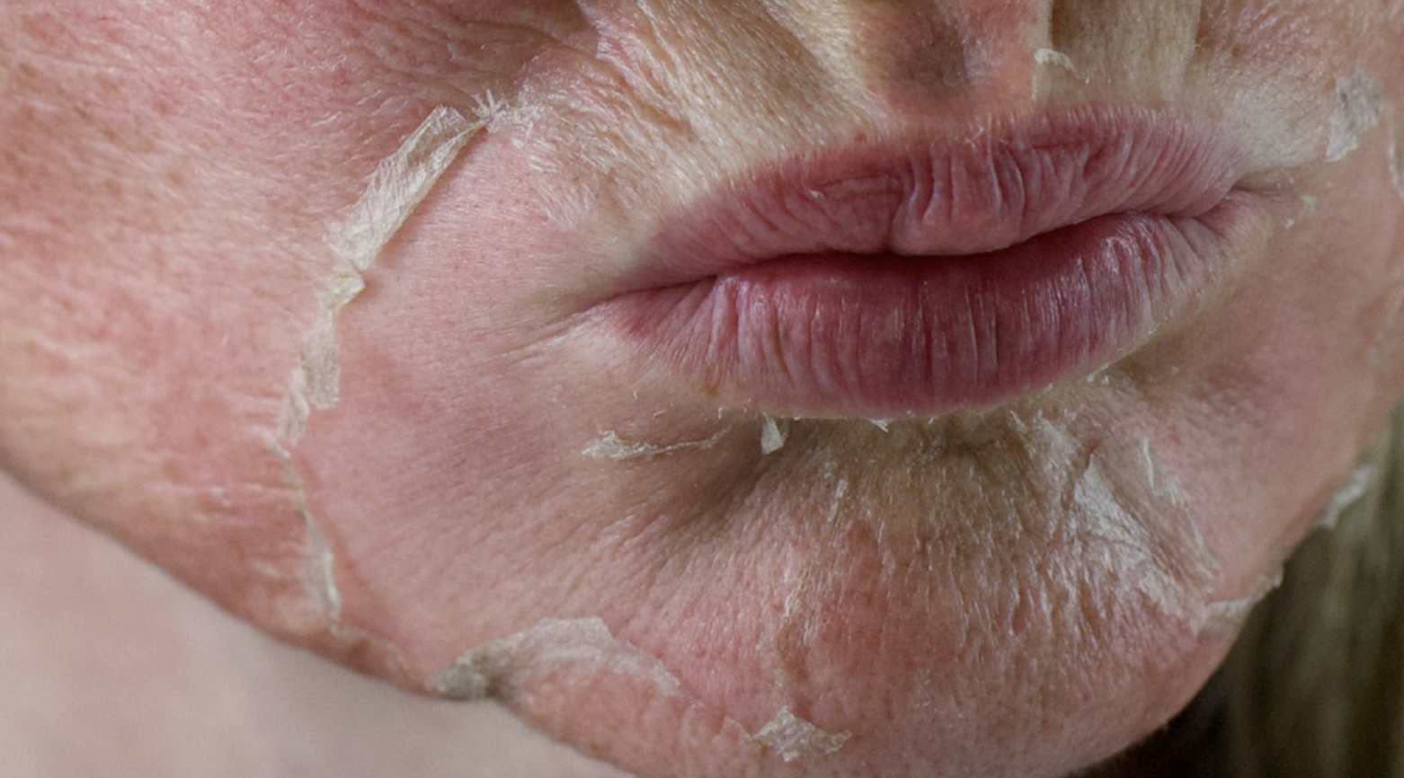 CHEMICAL PEELS 101: Acid Types