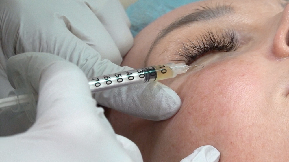 PRP Skin Rejuvenation Treatment - treatment image