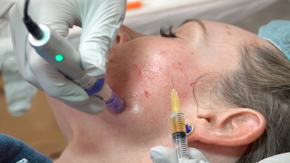 PRP Skin Rejuvenation Treatment - treatment image