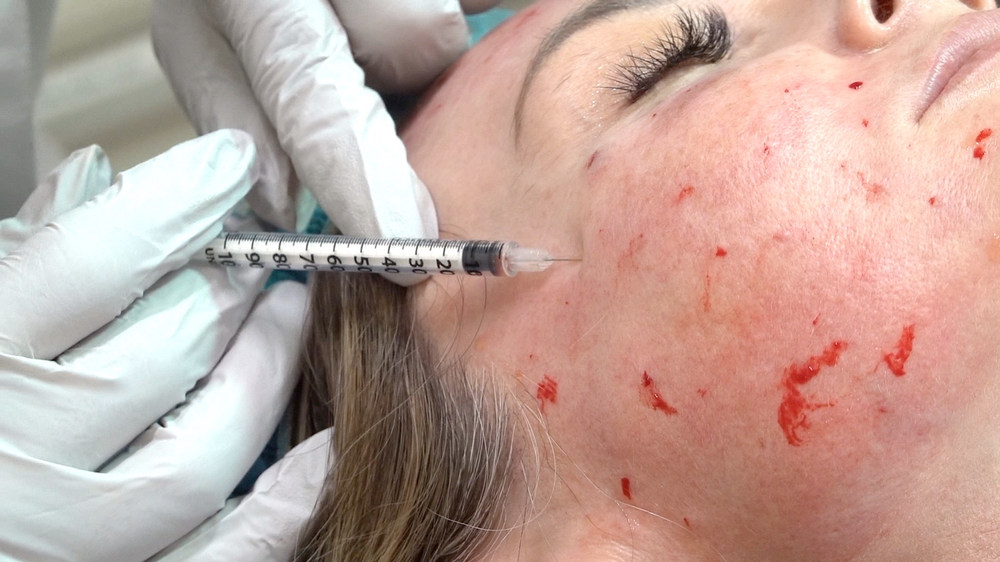 PRP Skin Rejuvenation Treatment - treatment image