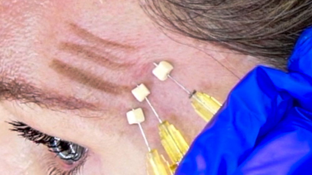 MESOSYS Age Return Carboxy Mask: Mesotherapy Treatment - treatment image