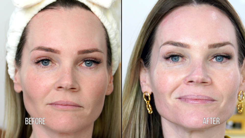 DIY TCA 30% + 5% Salicylic Peel - treatment image