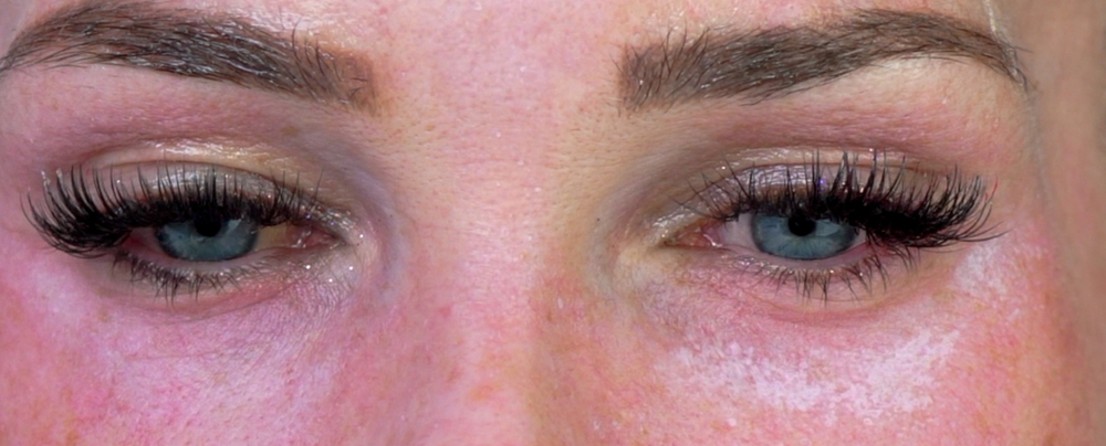 Under eye TCA acid Under eye TCA acid