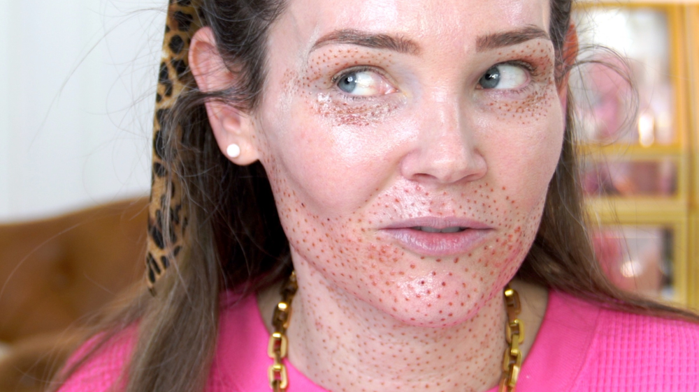 Plasma Fibroblast On Natural Kaos face