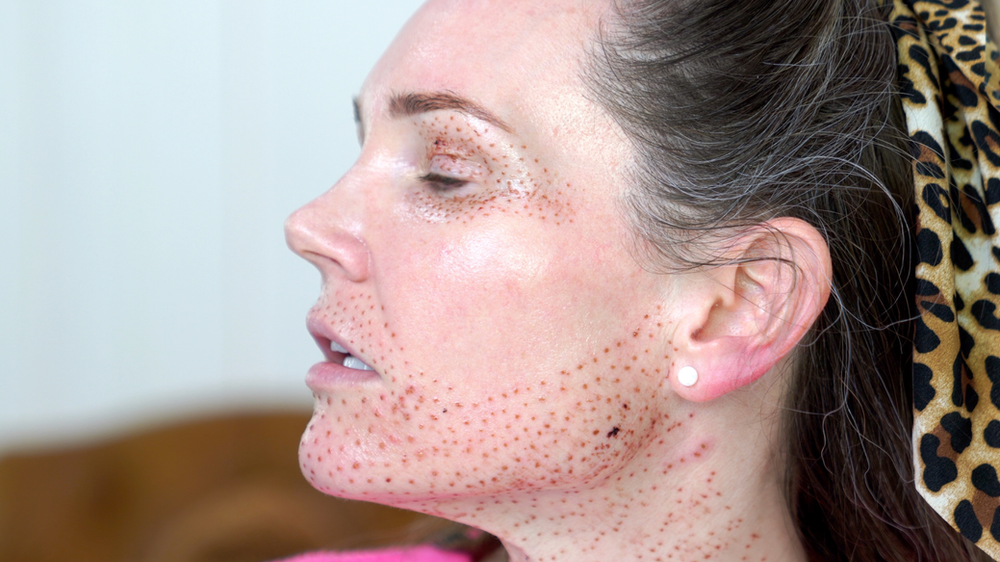 Left side of Face Natural Kaos Left side of face after plasma fibroblast treatment