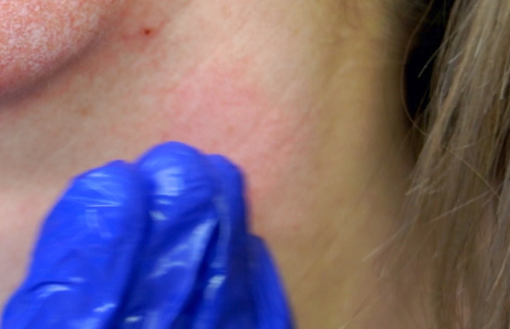 DIY TCA 30% + 5% Salicylic Peel - treatment image