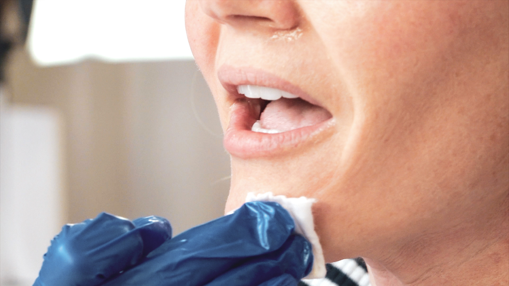DIY TCA 30% + 5% Salicylic Peel - treatment image