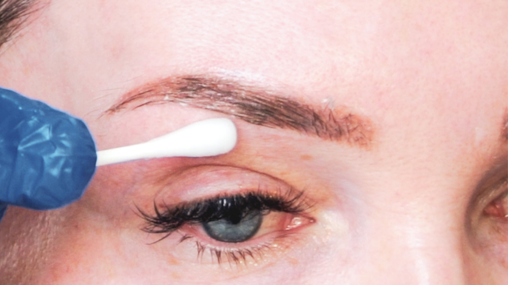 DIY TCA 30% + 5% Salicylic Peel - treatment image