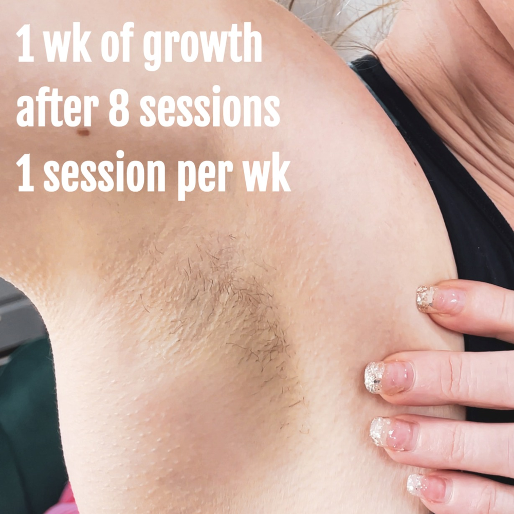 IPL Laser HAIR Removal At HOME - treatment image