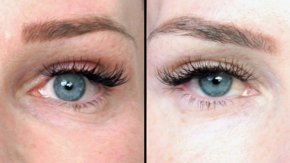 DIY TCA 30% + 5% Salicylic Peel - treatment image