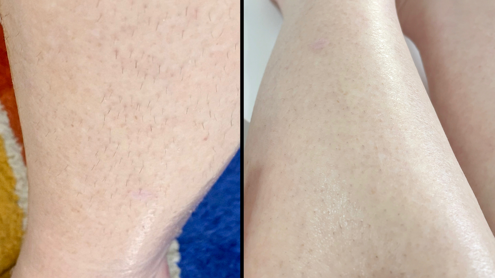 IPL Laser HAIR Removal At HOME - treatment image
