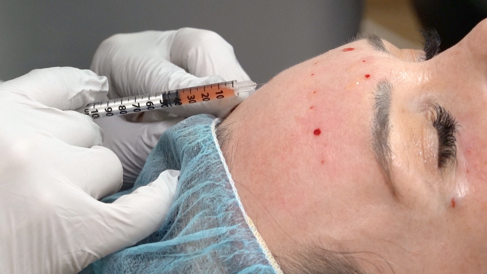 PRP Skin Rejuvenation Treatment