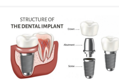 My TEETH Journey - treatment image
