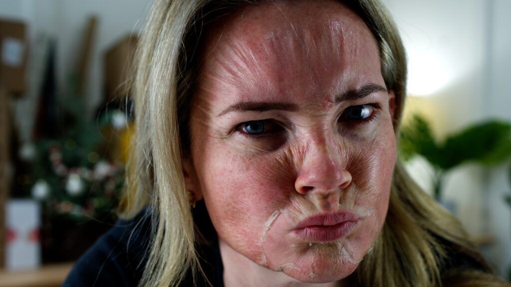 acid peels – 20% Jessner & 30% TCA Peel