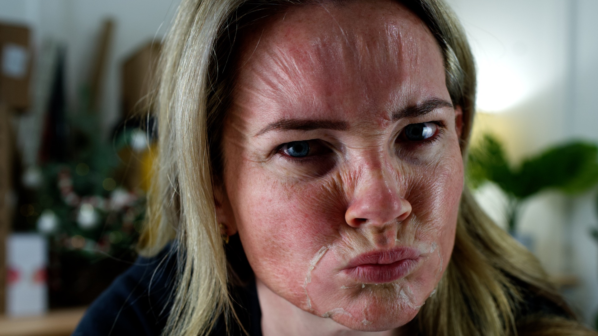 acid peels – 20% Jessner & 30% TCA Peel