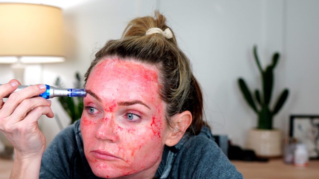 Microneedling Session #4