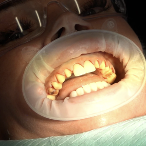 My TEETH Journey - treatment image