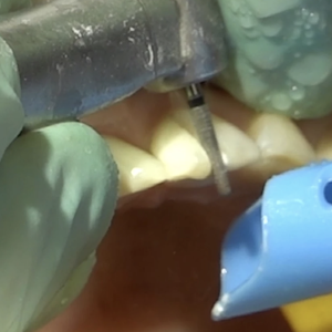 My TEETH Journey - treatment image