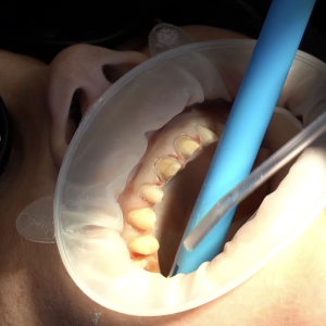 My TEETH Journey - treatment image