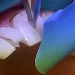 My TEETH Journey - treatment image