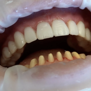 My TEETH Journey - treatment image
