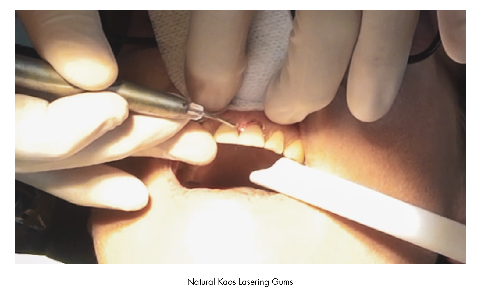 My TEETH Journey - treatment image