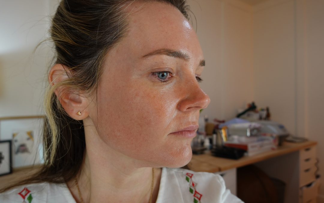 microneedling at home #7