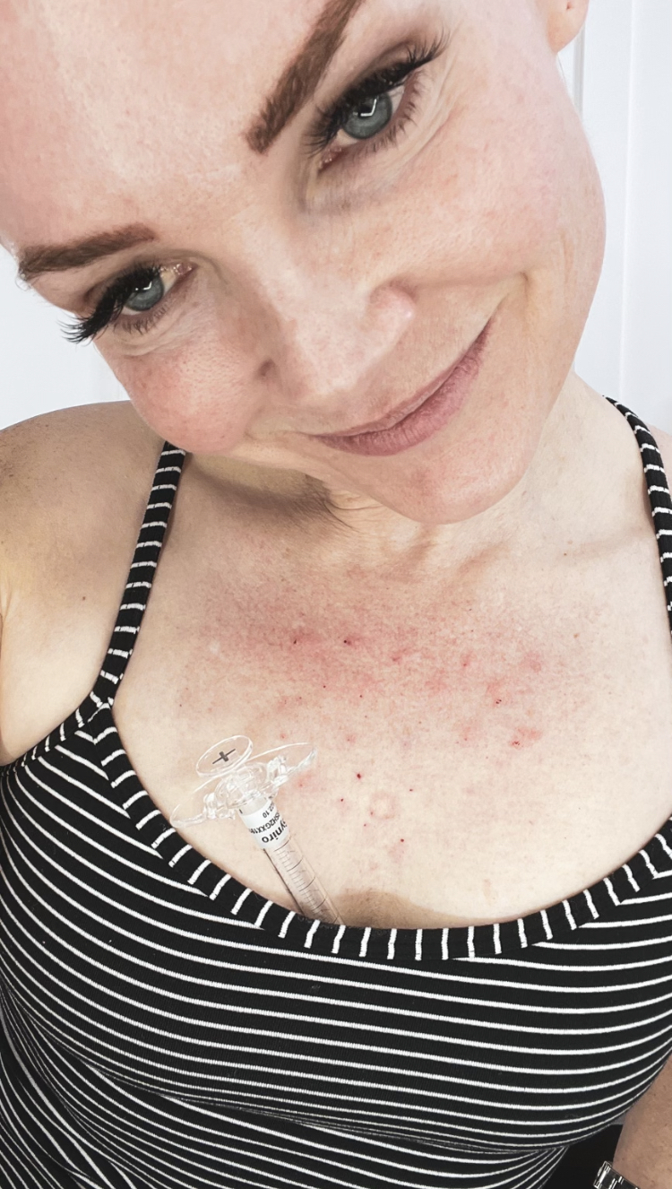 TOXIN Platysmal Bands and Syniro Mesotherapy - treatment image