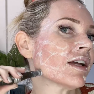 MICRONEEDLING WITH TRETINOIN NATURAL KAOS