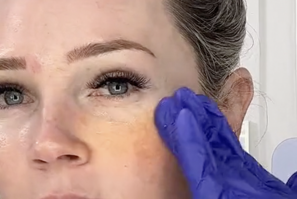 Can You Do Chemical Peels in the Summertime?