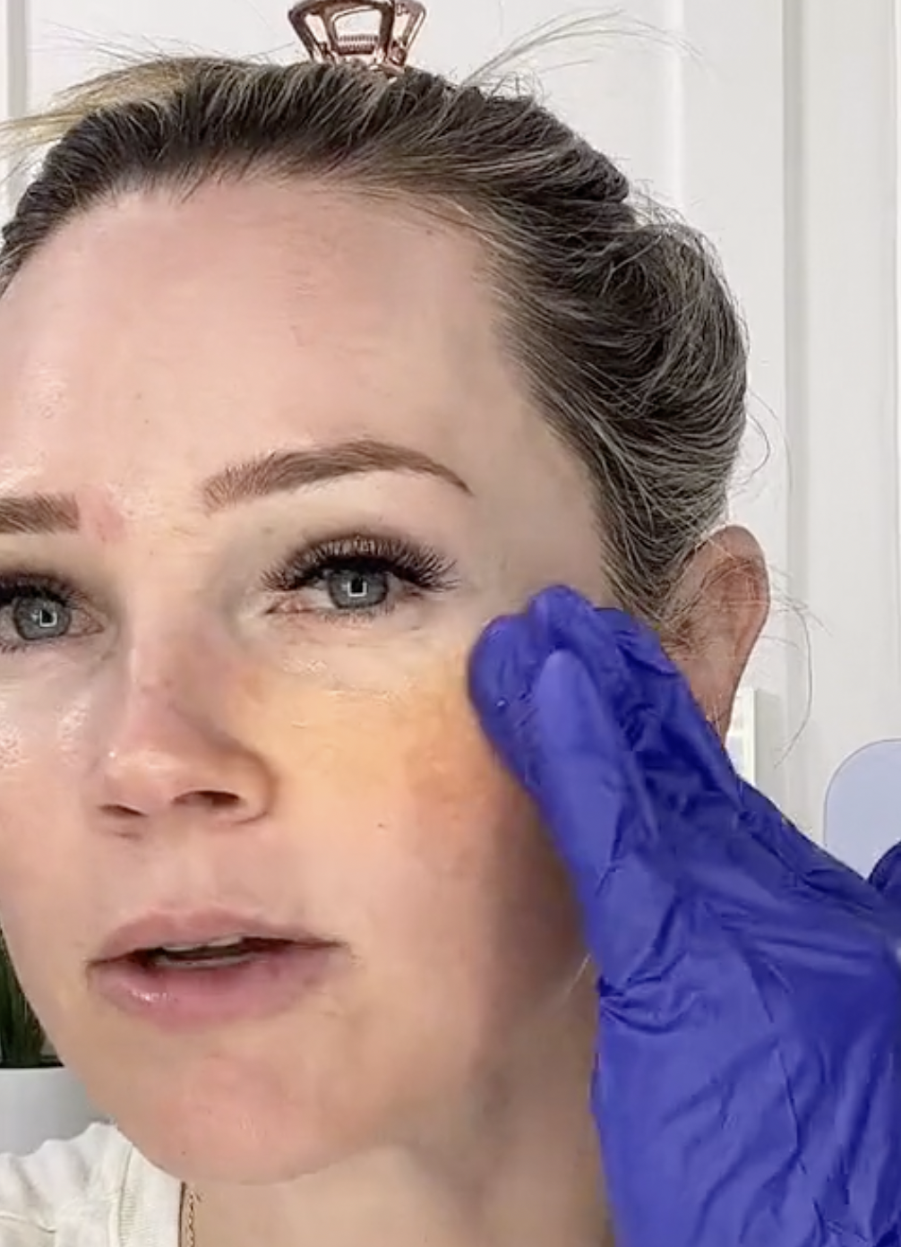 Can You Do Chemical Peels in the Summertime?