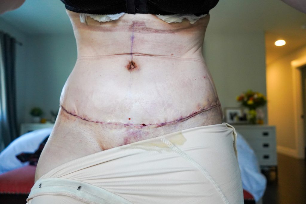 Patient K - 4 weeks Post-Operative Tummy Tuck and Sub-muscular