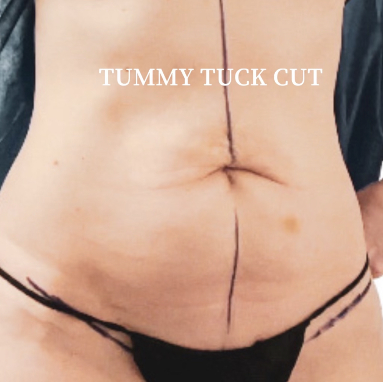 TUMMY TUCK POST OP NATURAL KAOS - Natural Kaos