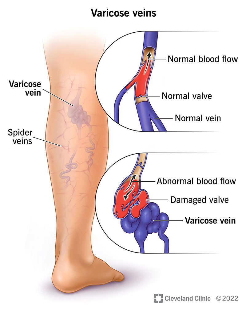 Varicose Veins and Spider Veins - treatment image