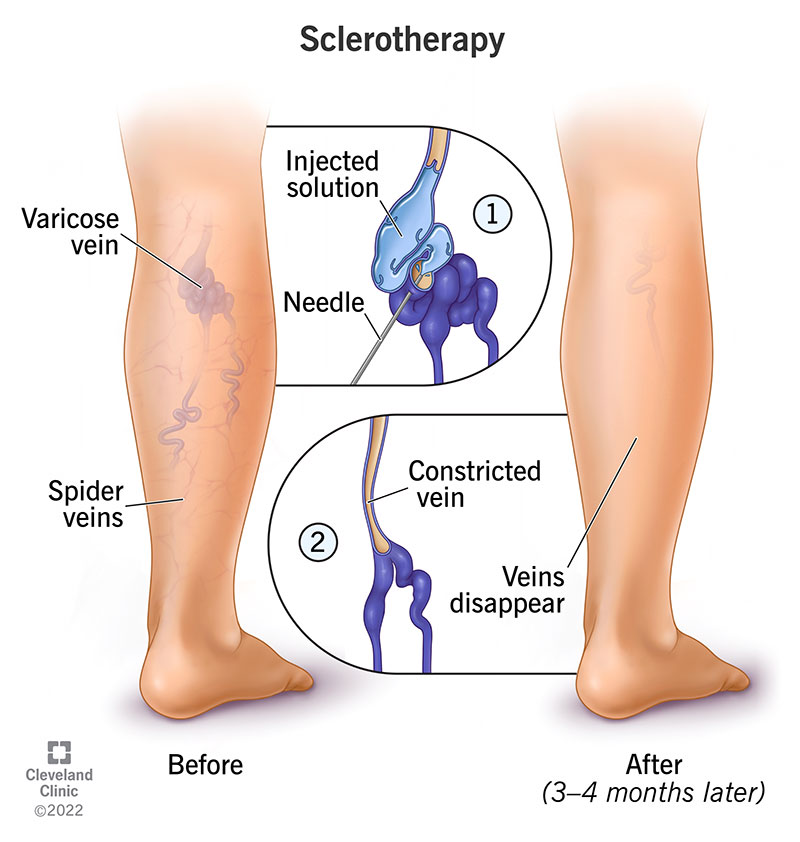 Varicose Veins and Spider Veins - treatment image
