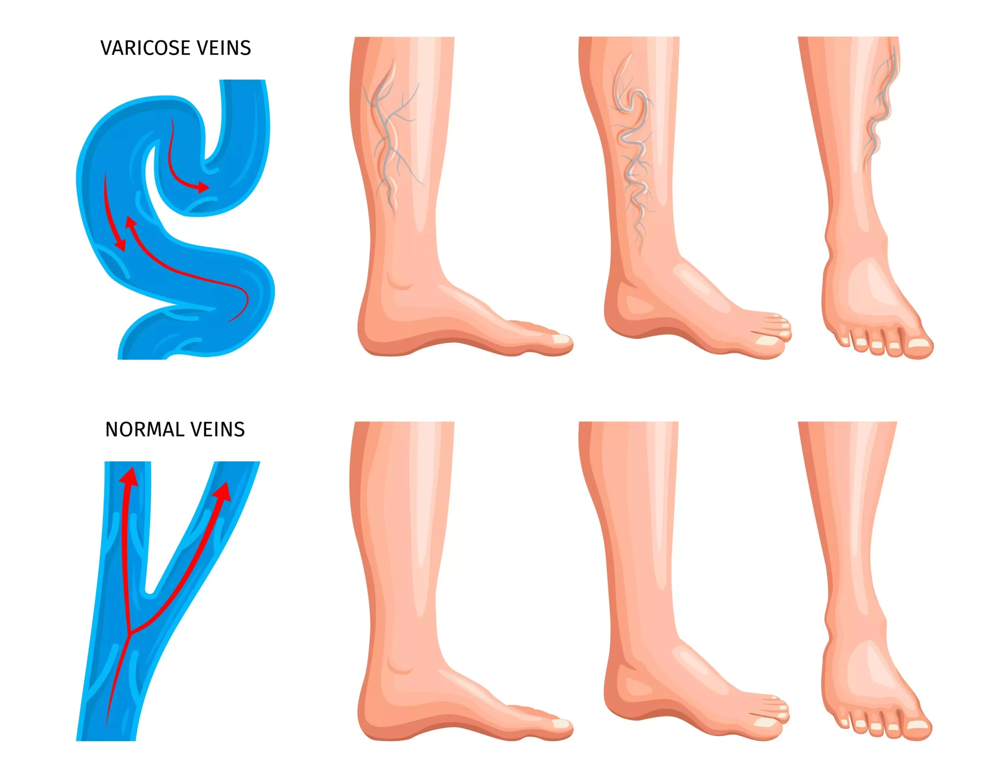 Varicose Veins and Spider Veins