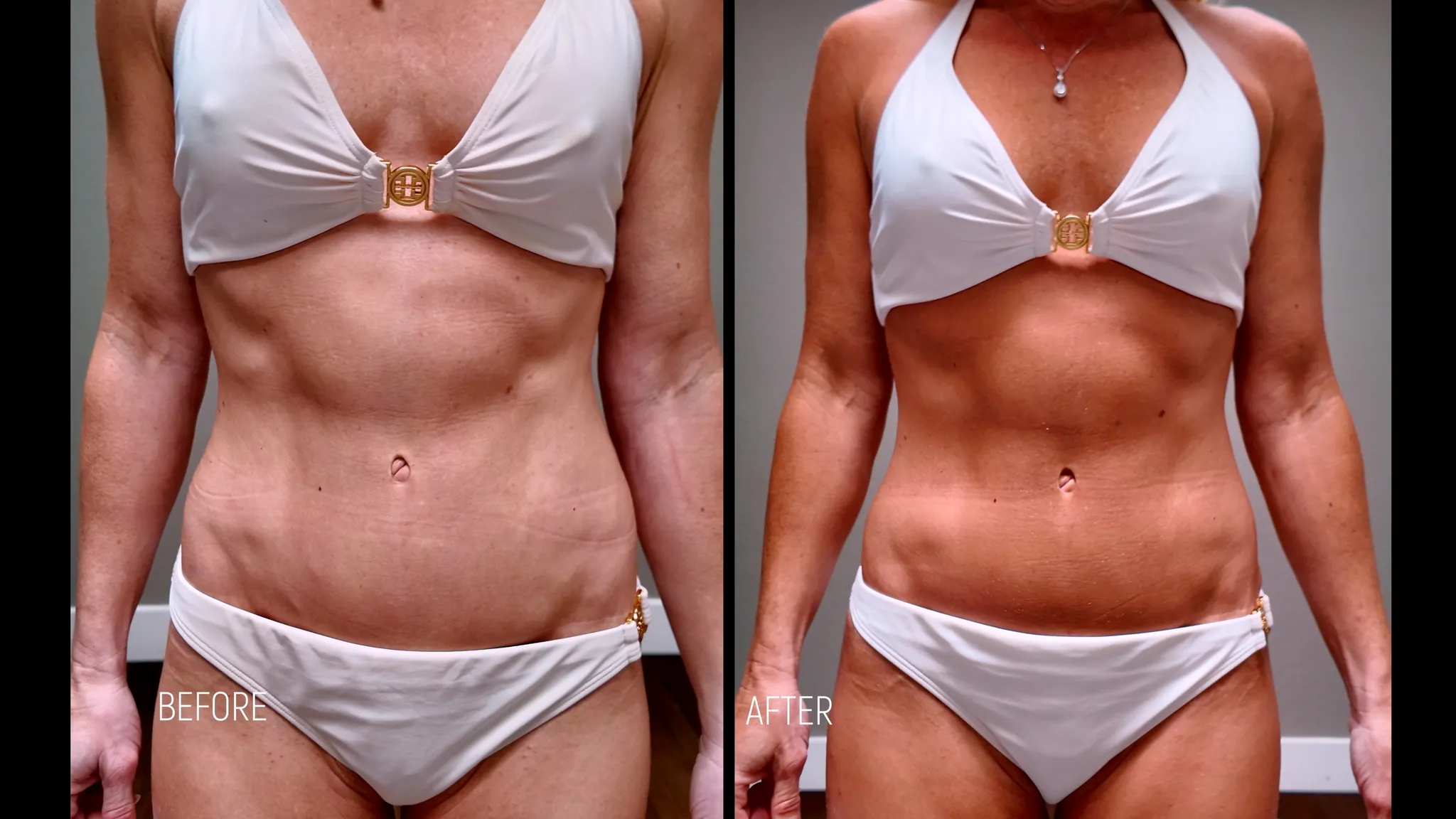 Watch Me Tan with Melanotan 2 (MT2) | Year 2 Results, Side Effects, & My Full Protocol - treatment image