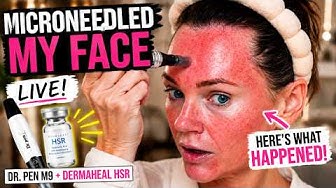 Microneedling with Dermaheal HSR | Hydrate, Firm & Rejuvenate Skin