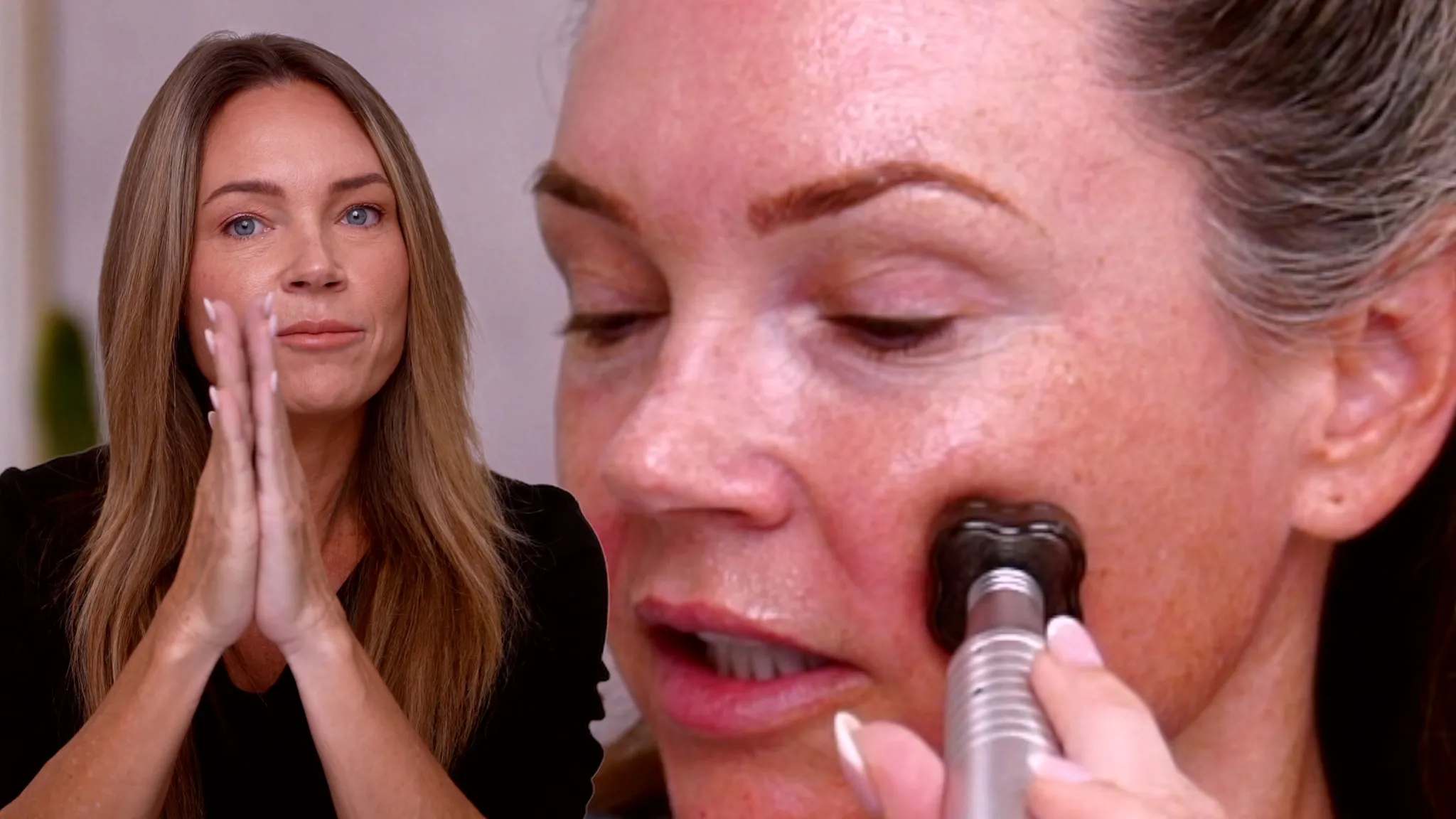 Tox + Exosome Microchanneling Facial with the Channel Pro Pen - treatment image