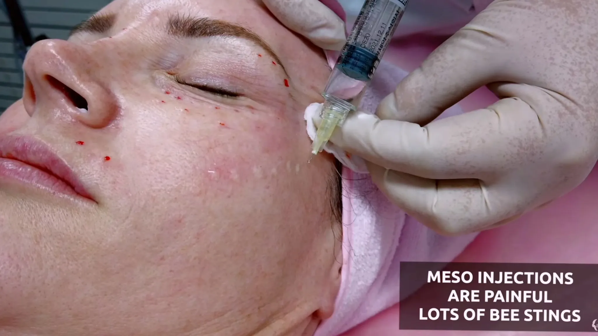 Microneedling vs Mesotherapy: Curenex PDRN Glow Booster Explained - treatment image