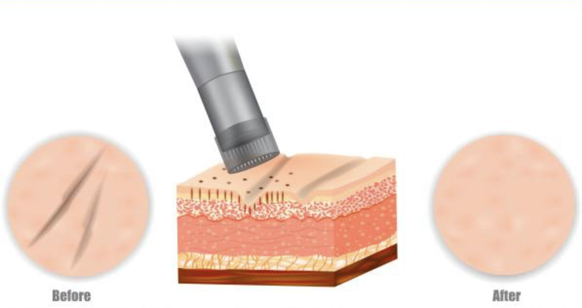 Body Microneedling for Loose Skin & Stretch Marks - treatment image