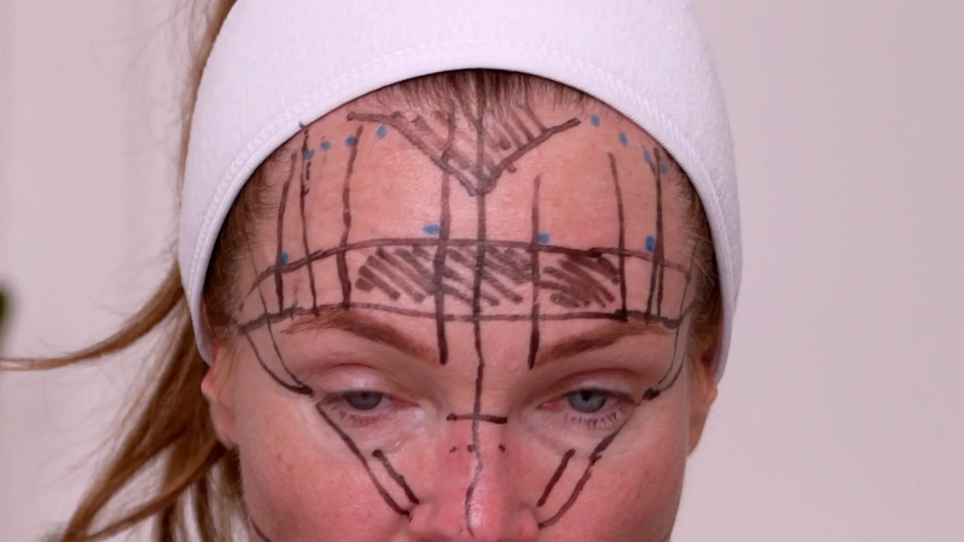 Face & Neck Map 200-UnitS Of Korean Toxin Dehantox - treatment image