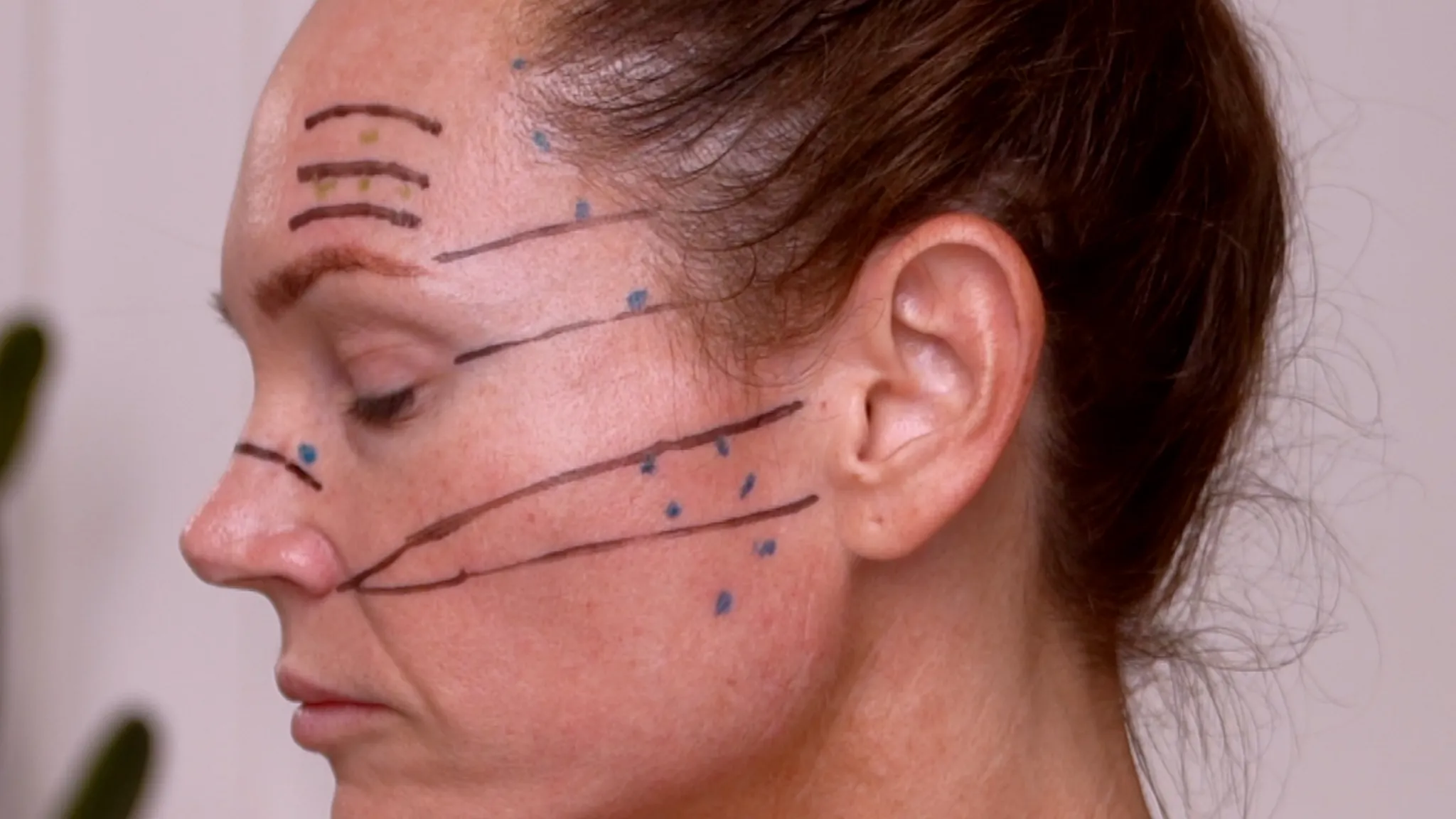 Dehantox 100U Mapping Update: Best Practices for Touch-Up Treatments - treatment image