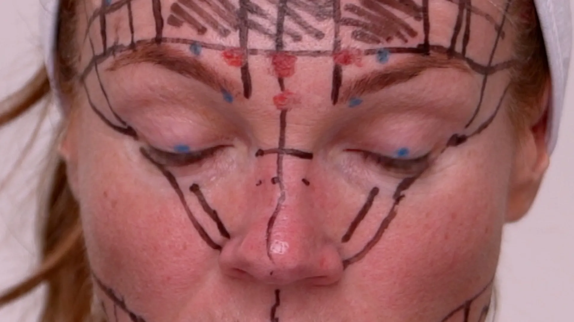 Face & Neck Map 200-UnitS Of Korean Toxin Dehantox - treatment image